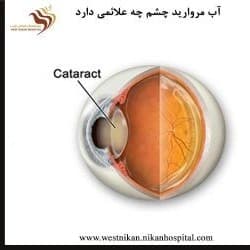 آب مروارید چشم چه علائمی دارد و انواع آن کدامند؟